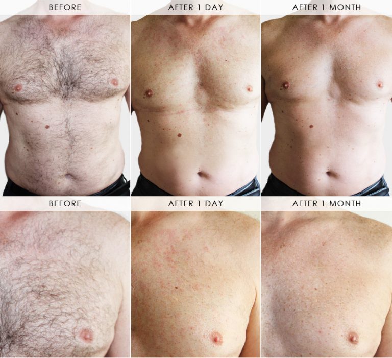 How Does Laser Hair Removal Work Smooth Laser Clinic Laser Hair
